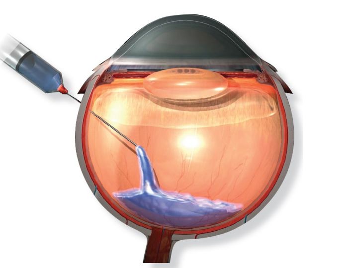Витрэктомия с тампонадой силиконовым маслом