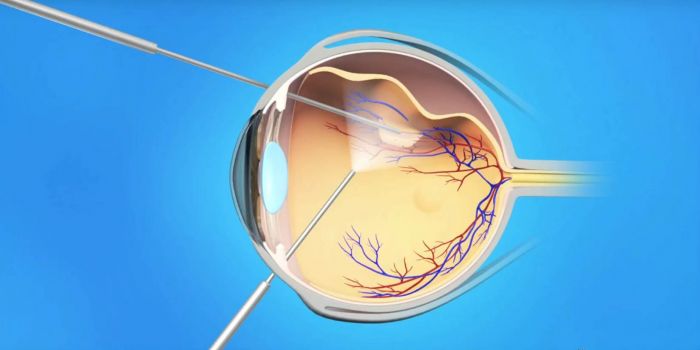 Микроинвазивная субтотальная витрэктомия с эндотампонадой и ...