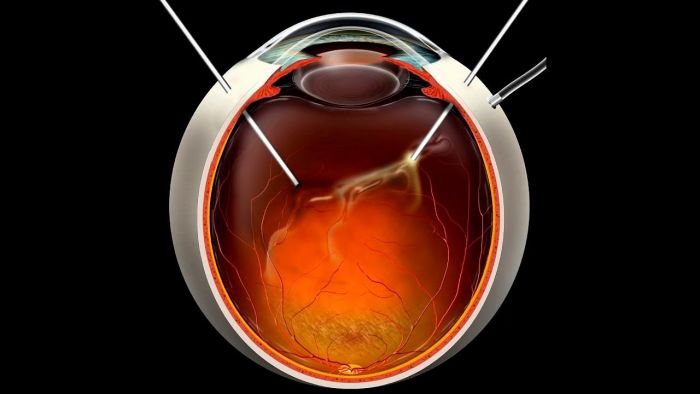 Микроинвазивная частичная витрэктомия с эндолазеркоагуляцией и ...