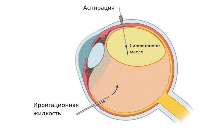 Удаление силиконового масла